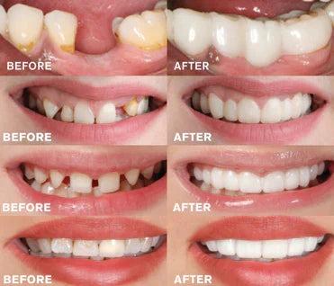 BrightDent SnapFit – Øjeblikkelig Tænderproteser for Et Perfekt Smil Bonusvis