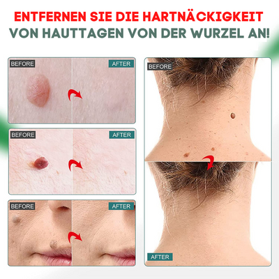 ClearSkinPro – Naturlig og Smertefri Løsning mod Hudmærker Bonusvis
